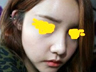 미스코+지방이식 후기여